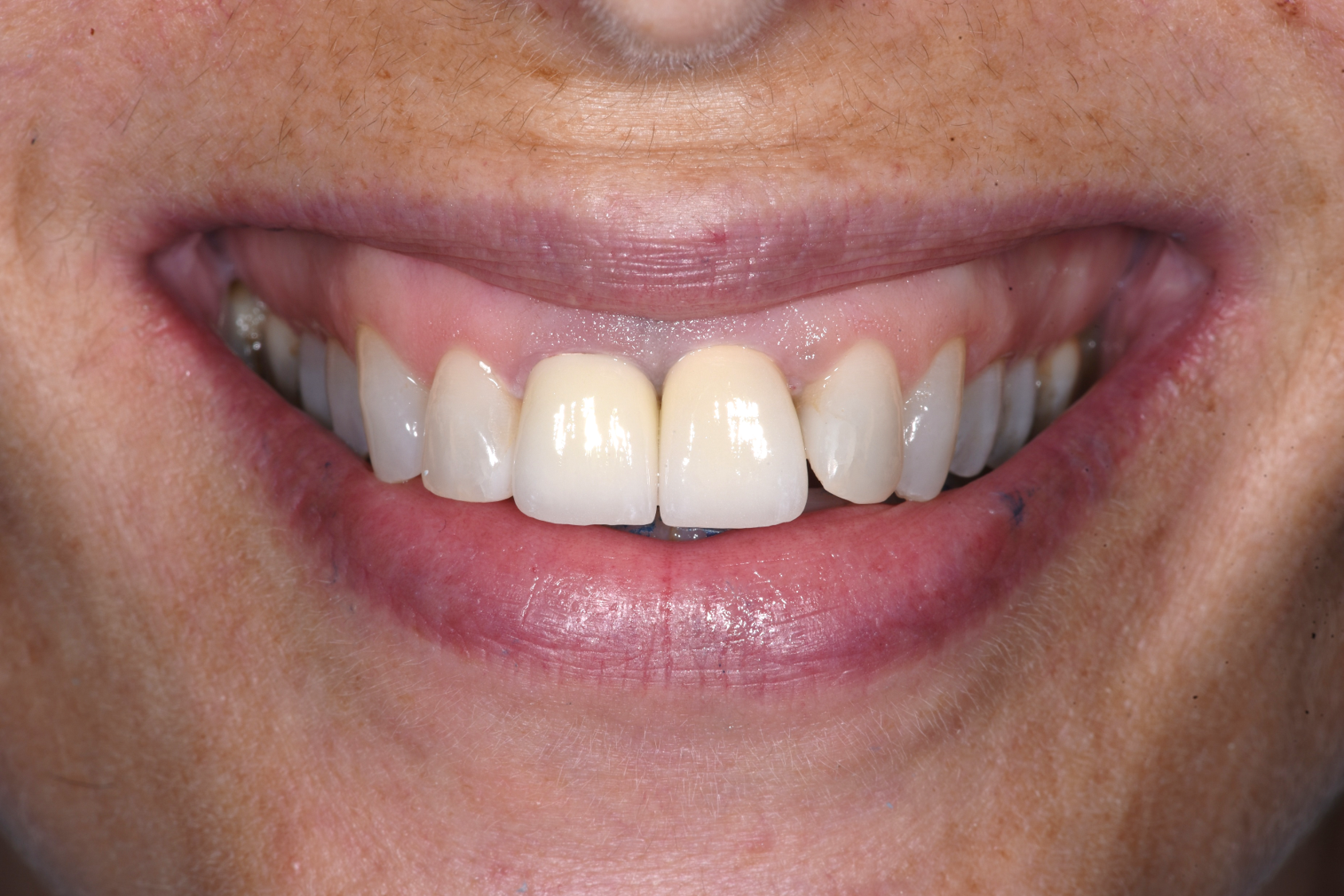 ב.ה. חיוך אחרי