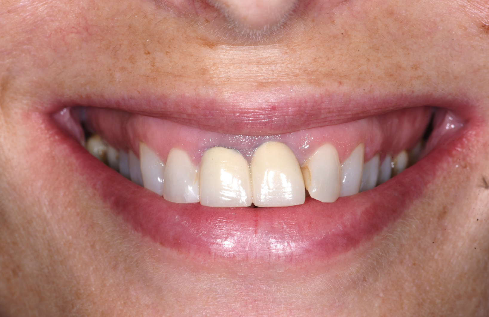 ב.ה. חיוך לפני