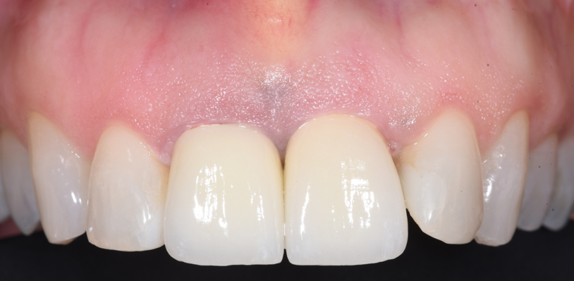 ב.ה. שיניים אחרי