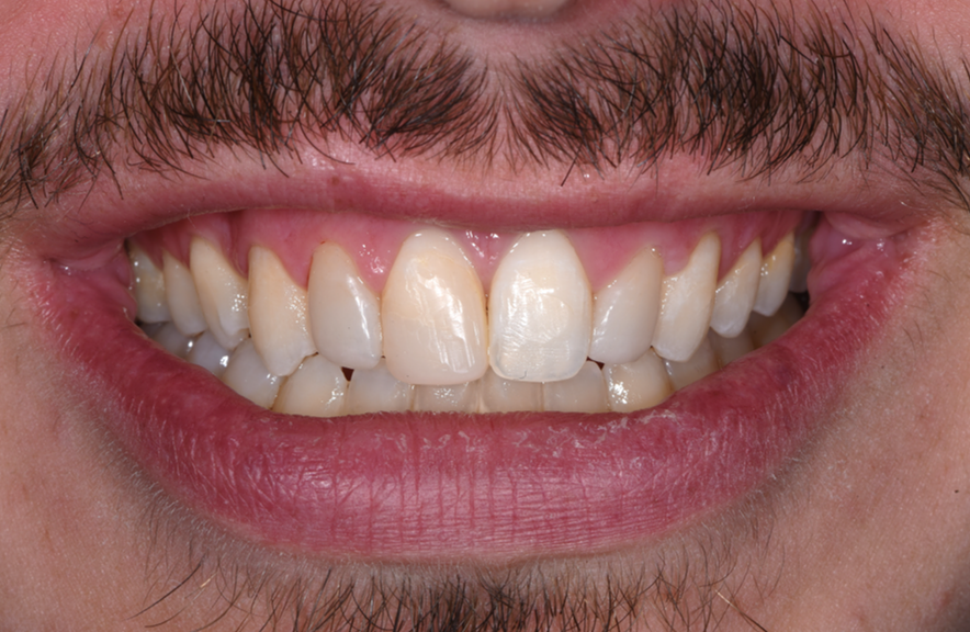 ב.ש. חיוך אחרי