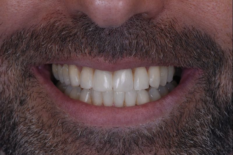 י.ח. חיוך אחרי