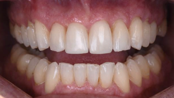 י.ח. שיניים אחרי