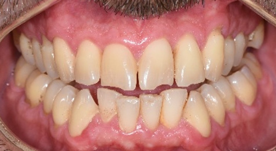 י.ח. שיניים לפני