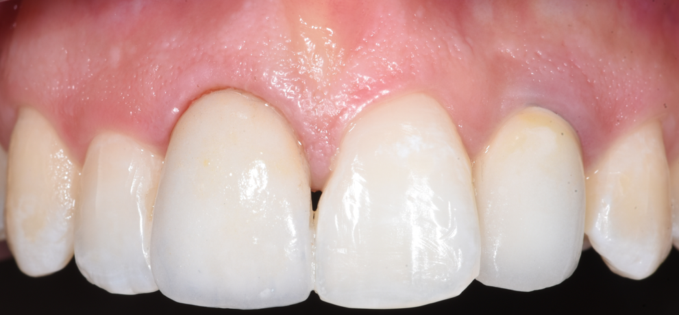 כ.ש. שיניים אחרי