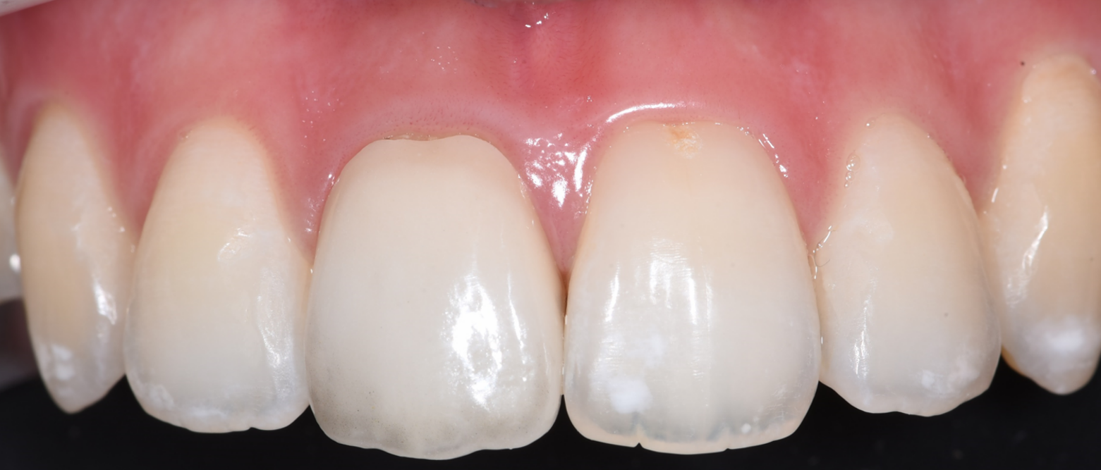 ל.ע. שיניים אחרי