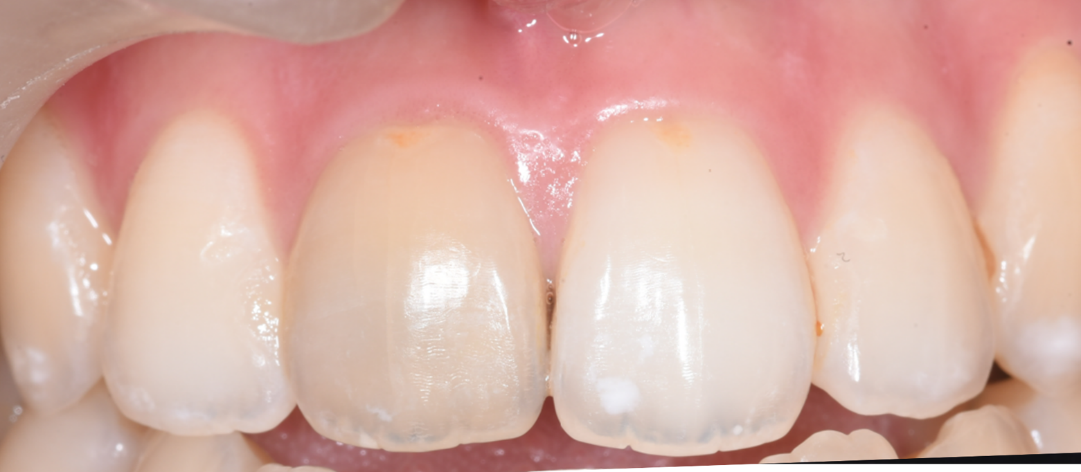 ל.ע. שיניים לפני