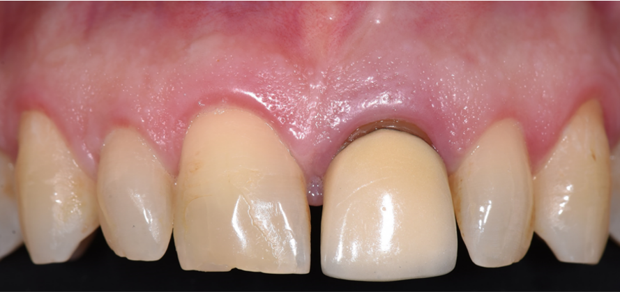 מ.י. שיניים לפני