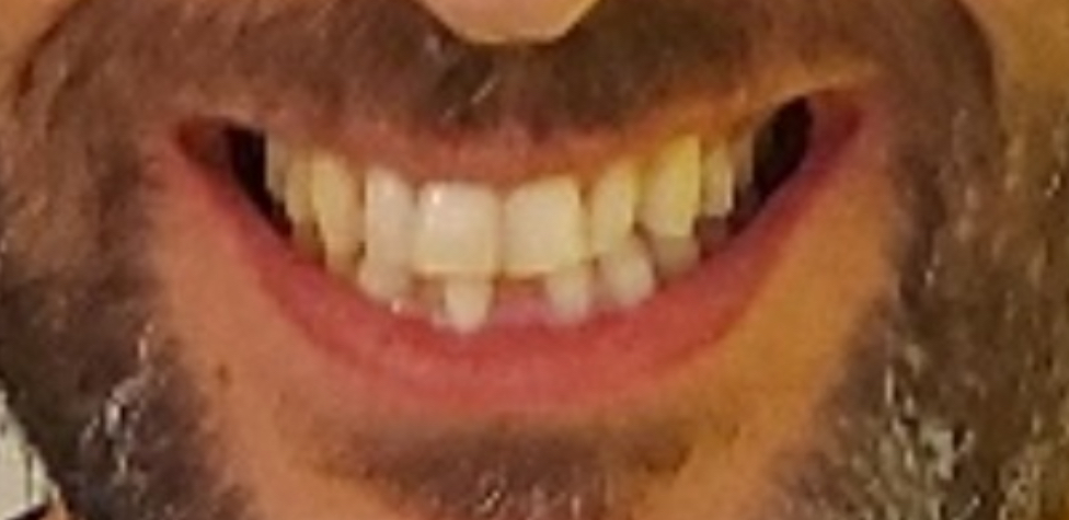 מ.ע. חיוך לפני