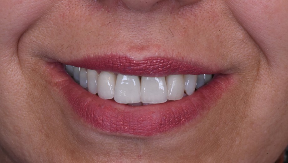 פ.י. חיוך אחרי