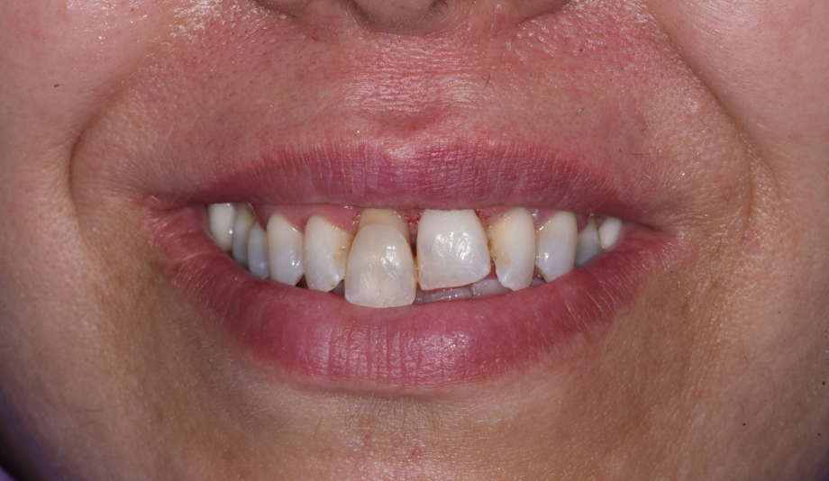 פ.י. חיוך לפני